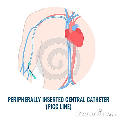 Peripherally inserted central catheter PICC line close up Vector Illustration