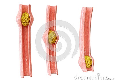 Peristalsis is the contraction of the muscles of the organs of the digestive tract allowing the movement of the bolus Stock Photo