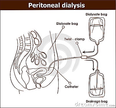 Peritoneal dialysis are both used to treat kidney - vector illus Vector Illustration