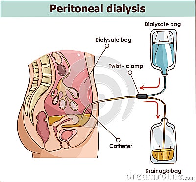 Peritoneal dialysis are both used to treat kidney - vector illus Vector Illustration