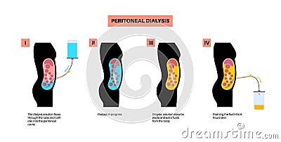 Peritoneal dialysis concept Vector Illustration
