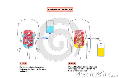 Peritoneal dialysis concept Vector Illustration