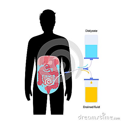 Peritoneal dialysis concept Vector Illustration