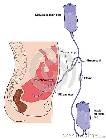 Peritoneal dialysis Vector Illustration