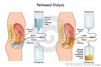 Peritoneal Dialysis Vector Illustration