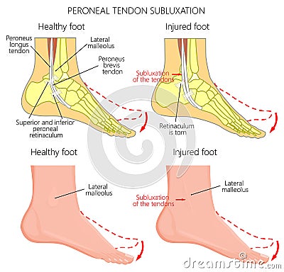 Peroneal Tendon Injuries_Peroneal tendon dislocation Vector Illustration