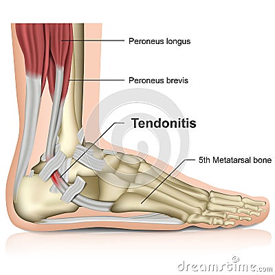 Peroneal tendonitis ,ankle joint 3d medical illustration Cartoon Illustration