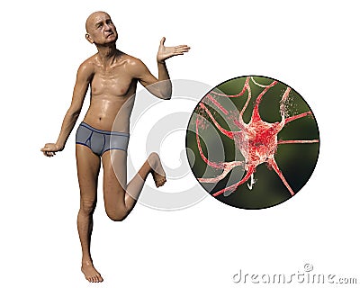 A person with chorea disease and close-up view of neuronal degradation Cartoon Illustration