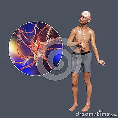 A person with chorea disease and close-up view of neuronal degradation Cartoon Illustration