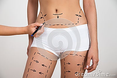 Person hand drawing lines on woman's abdomen and leg Stock Photo