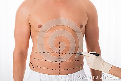 Person Hands Drawing Perforation Lines On Stomach Stock Photo