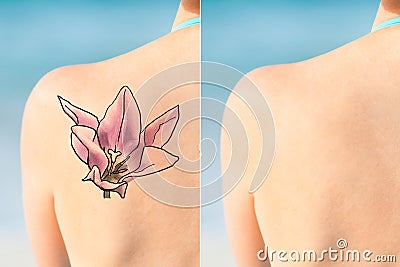 Person Showing Laser Tattoo Removal Treatment On Shoulder Stock Photo