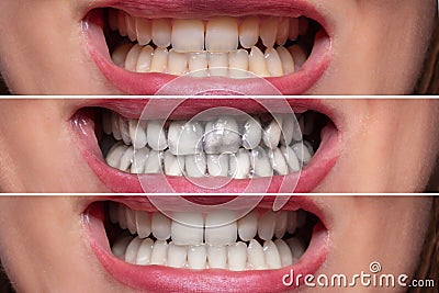 Person Teeth Before And After Cleaning Stock Photo