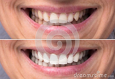 Person Teeth Before And After Whitening Stock Photo