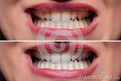 Person Teeth Before And After Whitening Stock Photo