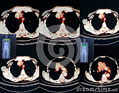 Pet/ct level of lungs Stock Photo