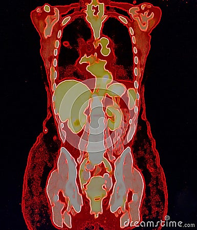 pet/ct of lung cancer Stock Photo