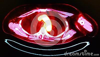 Pet ct right lower lobe mass primary lung neoplasm Stock Photo