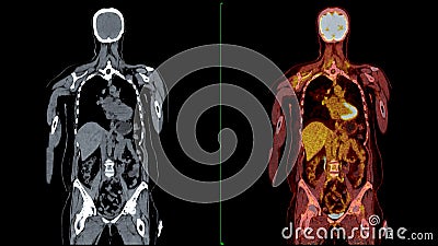 PET CT Scan fusion image It provides detailed images by merging Stock Photo
