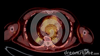 PET CT Scan fusion image It provides detailed images by merging Stock Photo