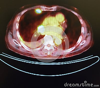 Pet ct tumor mediastinum penetrating lung frame Stock Photo
