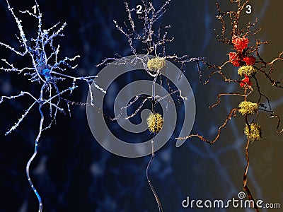 3 phases of the Alzheimer disease Stock Photo