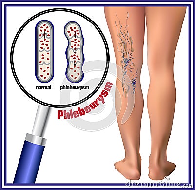 Phlebeurysm. Varicose veins. Vector Illustration