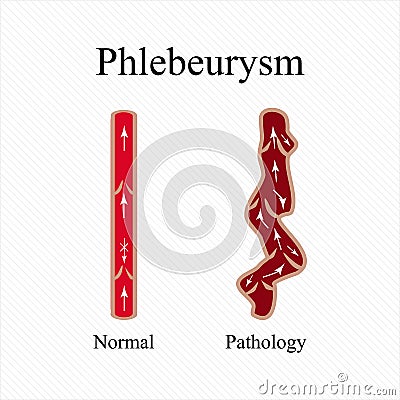 Phlebeurysm. Varicose veins. Venous disease. Infographics. Vector illustration Vector Illustration