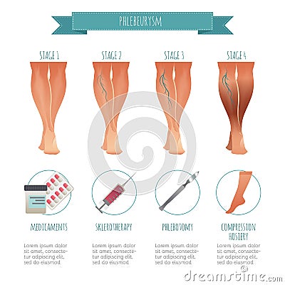 Phlebology infographic, treating varicose veins. Vector illustration of stage of vein diseases. Medical compression Vector Illustration