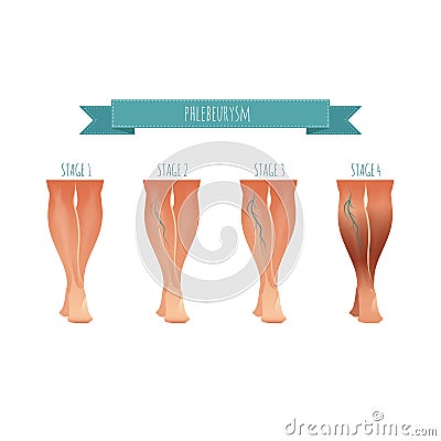 Phlebology infographic, treating varicose veins. Vector illustration of stage of vein diseases Vector Illustration