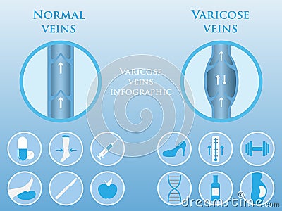 Phlebology vector infographics Vector Illustration