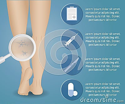 Phlebology vector infographics Vector Illustration