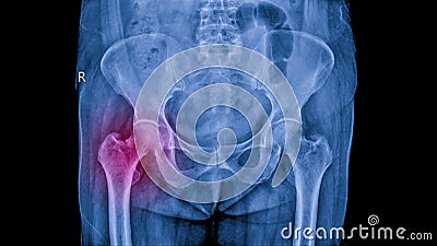 Non displace fracture of femoral neck in osteoporosis woman. Stock Photo