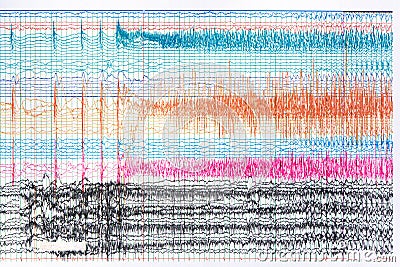 Photograph of ictal EEG during seizure Stock Photo