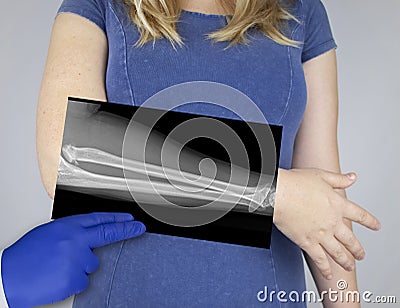 X-ray of a woman`s forearm. A photograph of the spoke-bone and ulna bones is brought to the patient`s hand. Radiologist examine Stock Photo