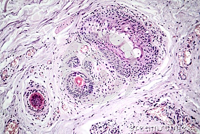 Basal cell carcinoma, light micrograph Stock Photo