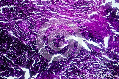 Photomicrograph of lung tissue with silicosis pathology under a microscope, revealing silica particle accumulation in alveoli and Stock Photo