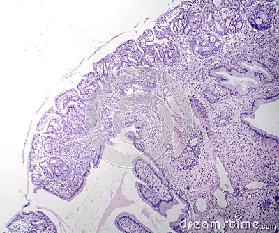 Nasal polyps, light micrograph Stock Photo