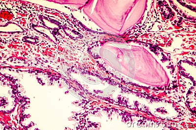 Photomicrograph of prostate hyperplasia Stock Photo