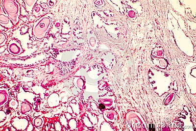 Photomicrograph of prostate hyperplasia Stock Photo