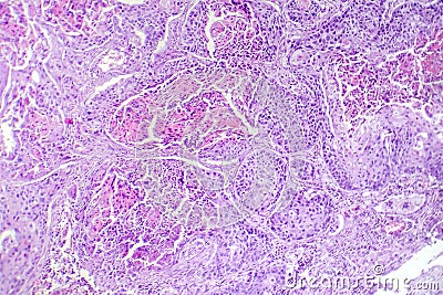 Squamous cell carcinoma of the lung, light micrograph Stock Photo