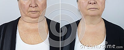 Photos before and after plastic surgery to remove Venus rings. Contour plastics of the neck, mesotherapy or botulinum therapy. Stock Photo