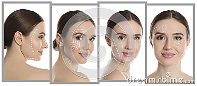 Photos of woman with lifting marks on face against white background, collage. Cosmetic surgery Stock Photo