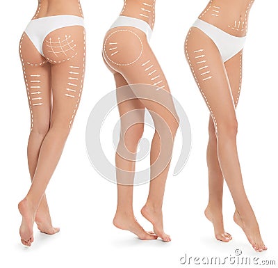 Photos of young woman with marks on body against background, collage. Cosmetic surgery concept Stock Photo