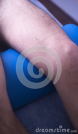Physical therapy acupunture Stock Photo