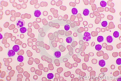 Picture of acute lymphocytic leukemia or ALL Stock Photo