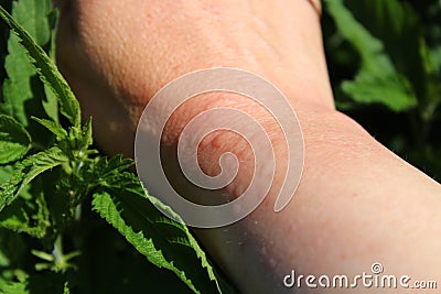Stinging nettles and an arm with nettle stings Stock Photo