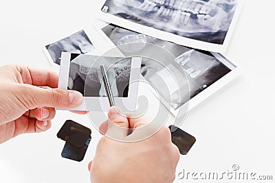 Picture sick tooth, gums Stock Photo