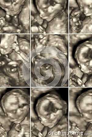 Pictures of 4D Ultrasound of baby in mother's womb. Collage of 3D Echography images Stock Photo