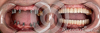 Before and after pictures of dental implants and press ceramic crowns Stock Photo